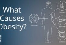 Obesity: Causes, Health Conditions, and Treatment | Mass