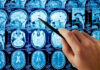 Hand pointing at brain scan images on screen.