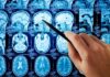Dementia Math STUNS — 45% on the Line A hand pointing at MRI brain scans displayed on a screen
