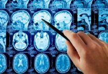 Dementia Math STUNS — 45% on the Line A hand pointing at MRI brain scans displayed on a screen